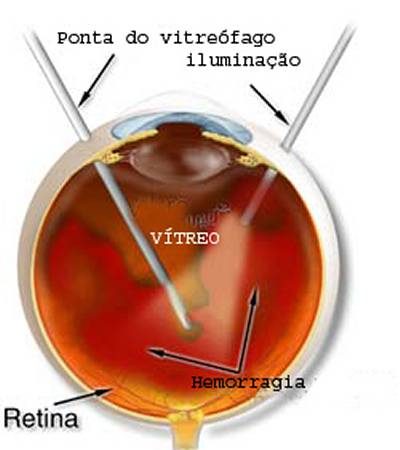 Cirurgia Vitreo-Retiniana
